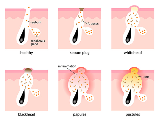 blackheads, pimples and papules